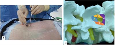 A meta-analysis of clinical effects of microscopic unilateral laminectomy bilateral decompression (ULBD) versus biportal endoscopic ULBD for lumbar canal stenosis